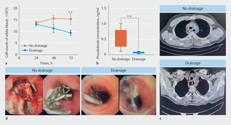 Preventive wound drainage reduces esophageal fistula or infection after endoscopic resection of giant submucosal tumors in the esophagus.