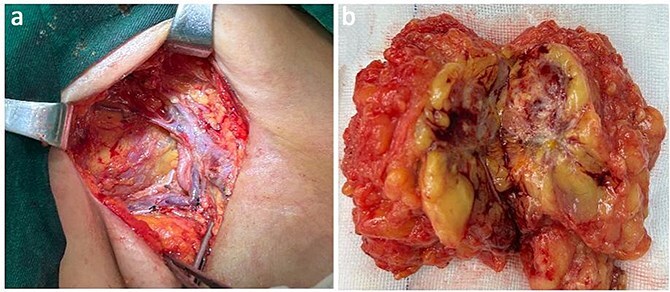 Metastatic epithelioid sarcoma on the arm: presentation of a case report.