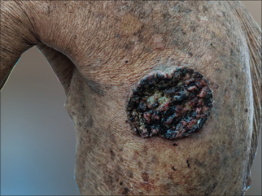 Huriez Syndrome.