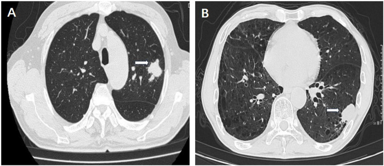 SMARCA2 Deficiency While Preserving SMARCA4 in Lung Adenocarcinoma Combined with Abnormal β-Catenin Expression.