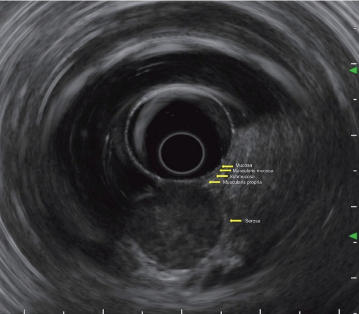 Approach to Gastric Subepithelial Lesions: From Differential Diagnosis to Histologic Confirmation.