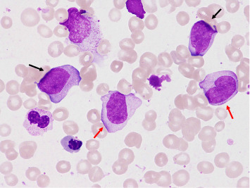 Successful Treatment of Leukemic Synovitis Complicated With Chronic Myelomonocytic Leukemia.
