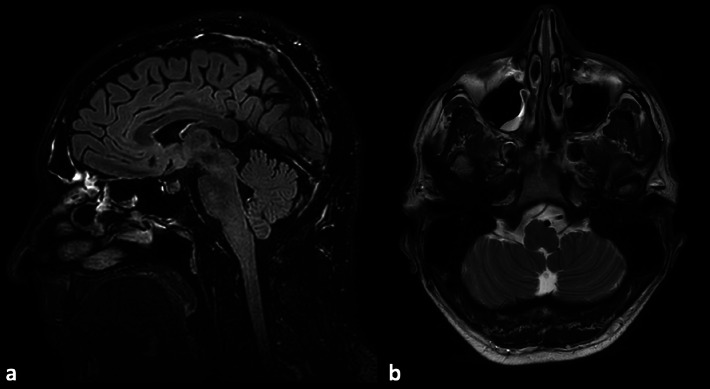 Neuroimaging in PRES: Isolated Brainstem and Spinal Cord Involvement Secondary to Aorto-Iliac Occlusive Disease-A Unique Case Report.
