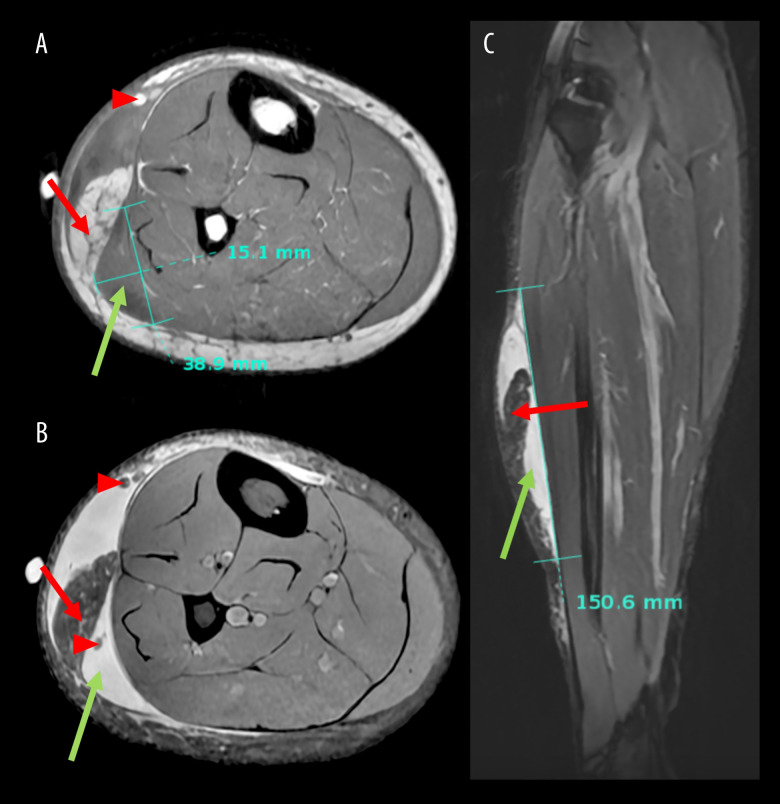 Adolescent Morel-Lavallée Lesions: A Case Report of Challenges in Diagnosis and Management in Atypical Locations.