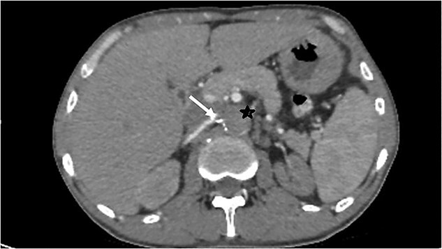 Lerich syndrome revealed by renal failure: a case report.
