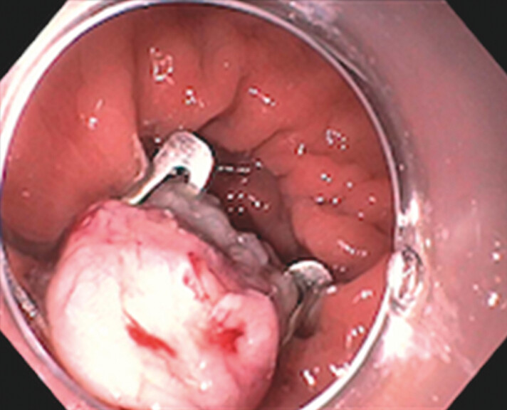 Assessing outcomes of full-thickness resection in piecemeal polypectomy scar consolidation of colon adenomas containing cancer.