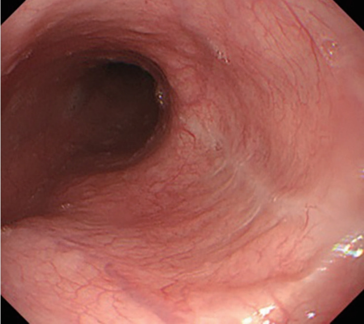 Esophageal Rupture Occurred During the Endoscopic Removal of a Lodged Denture.