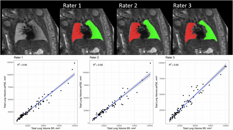 Lung volume segmentation in fetal MRI: super-resolution reconstructions improve inter-rater reliability.