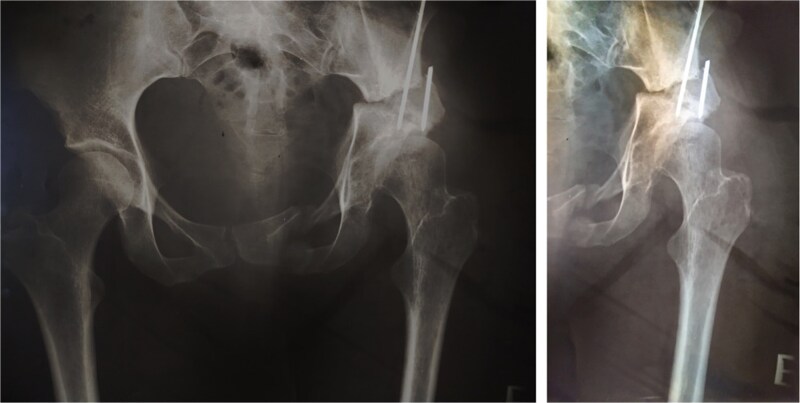 Hybrid total hip arthroplasty 28 years after Pol Le Cœur triple pelvic osteotomy used for the treatment of developmental dysplasia of the hip: a case report.