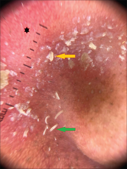 Seborrhoea Herpeticum: A distinct entity or mere coincidence.