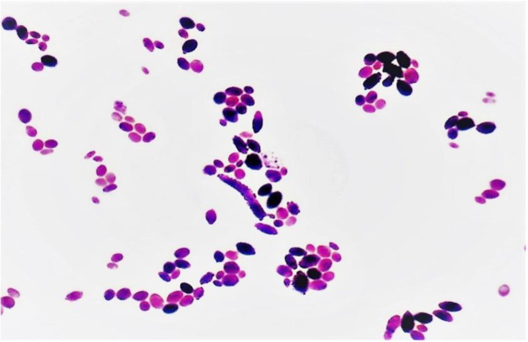 Central line-associated <i>Cyberlindnera fabianii</i> fungemia: A case report and review of diagnostic and therapeutic challenges.