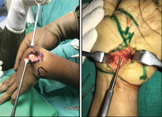 Neglected Isolated Lunate Dislocation in a Polytrauma Patient Presenting as Acute Carpal Tunnel Syndrome - A Case Report with Review of Literature.