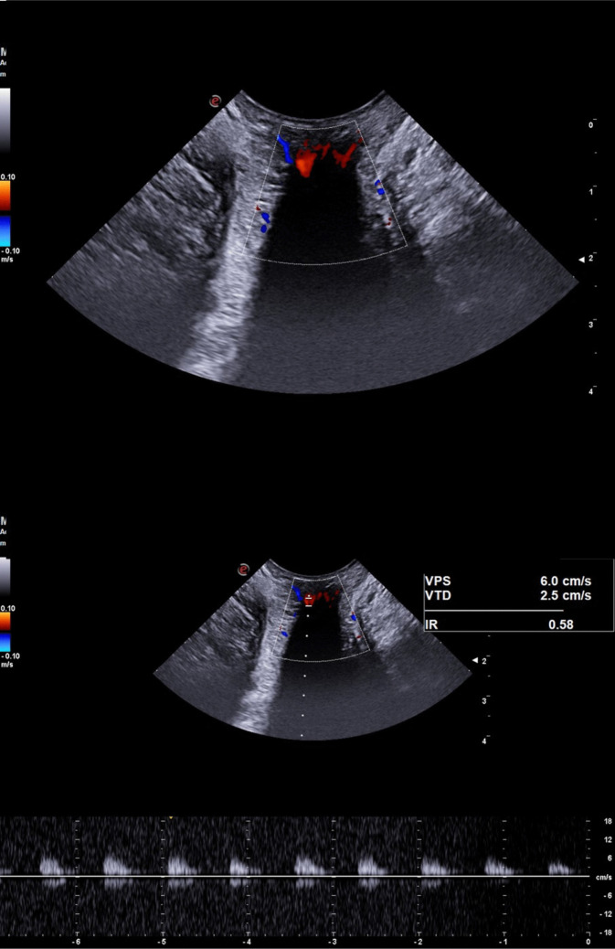 Arterial flow in healthy individuals and patients with hemorrhoidal disease: a Doppler ultrasound-based pathophysiological analysis.