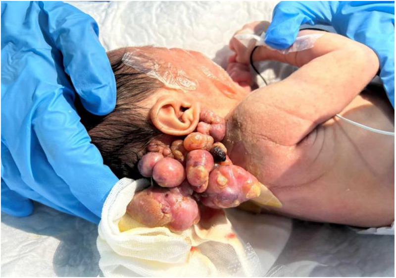 Case Report: Multidisciplinary management and nursing care for a preterm infant with rare extrarenal malignant rhabdoid tumor: a clinical case study.