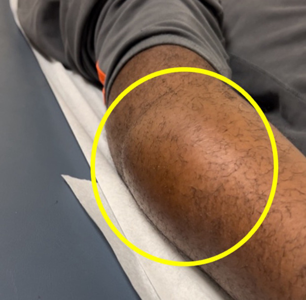 Adolescent Morel-Lavallée Lesions: A Case Report of Challenges in Diagnosis and Management in Atypical Locations.