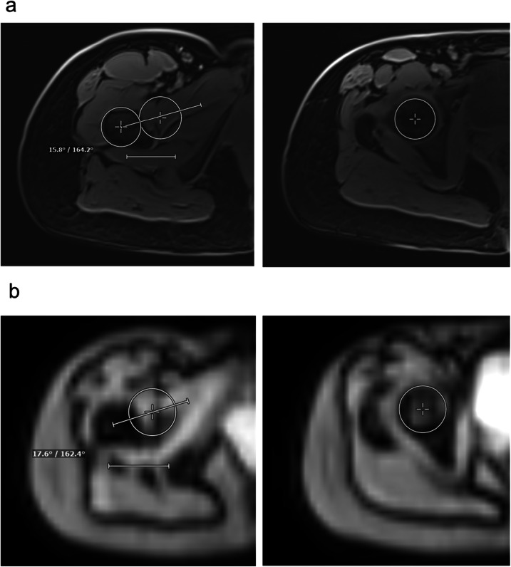 3D isotropic FastView MRI localizer allows reliable torsion measurements of the lower limb.