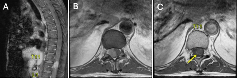 GNAQ mutation in primary spinal melanoma: illustrative case.
