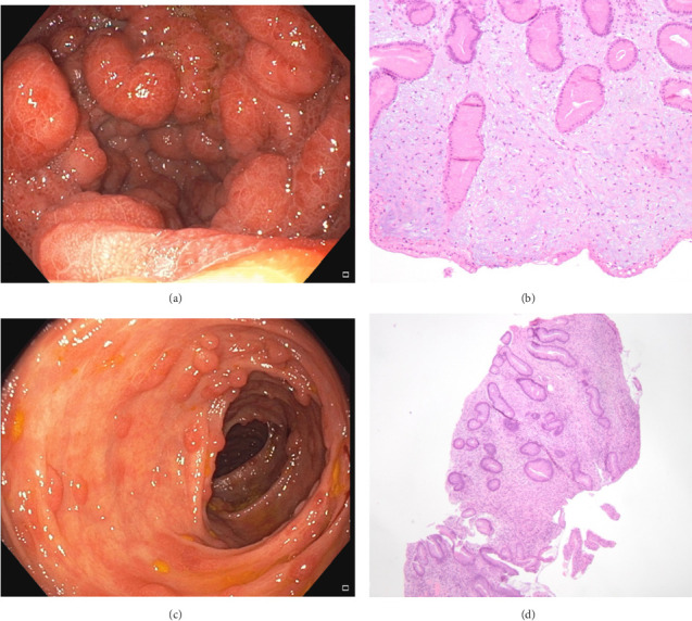 An Unusual Presentation of Cronkhite-Canada Syndrome With Hypothyroidism.