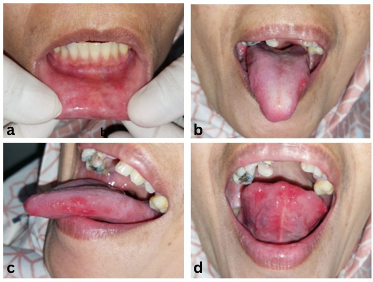 Salted Fish and Their Impact on Oral Health: A Risk for Lichen Planus.
