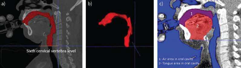 Oropharyngeal enlargement in obstructive lung disease: quantification and machine learning.