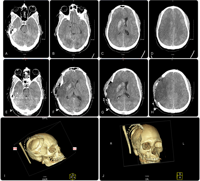 Managing malignant middle cerebral artery infarction with open scalp incision and partial hemispherectomy: illustrative case.