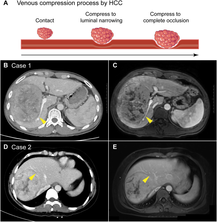 Tumor Compression of the Hepatic or Portal Vein Predicts the Presence of Microvascular Invasion and Satellite Nodules in Hepatocellular Carcinoma: A Retrospective Study.