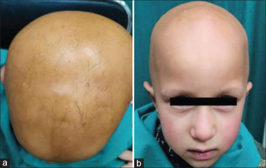 Role of Trichoscopy in diagnosing Genotrichosis-A Report of Two Cases.