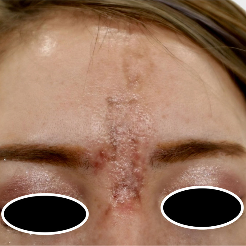 Late Intervention Yet Successful Outcome with High-dose Pulsed Hyaluronidase for Forehead Filler Vascular Complication.