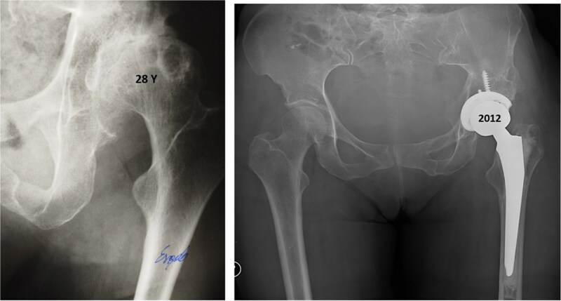 Hybrid total hip arthroplasty 28 years after Pol Le Cœur triple pelvic osteotomy used for the treatment of developmental dysplasia of the hip: a case report.