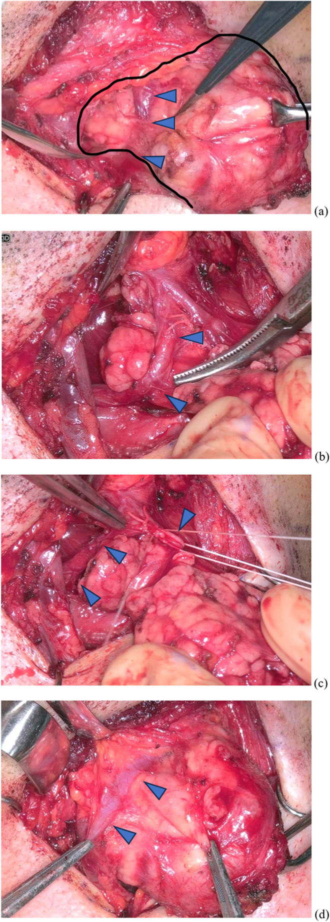 Enhancing submandibular gland resection: A retrospective study on the efficacy of the ORBEYE 3D exoscope.