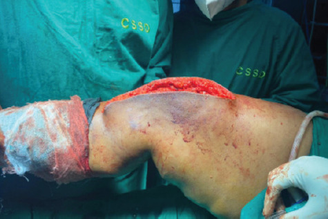 Successful Management of Quadriceps Tendon Tear with Repair and Augmented with Semitendinosus Graft -A Case Series.