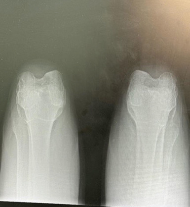 Congenital Absence of Bilateral Patella in an Active Military Personnel Case Report.