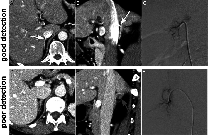 High-resolution 0.25 mm Detector CT Has Limited Impact on Right Adrenal Vein Detectability in Preprocedural Contrast Enhanced CT for Adrenal Venous Sampling.