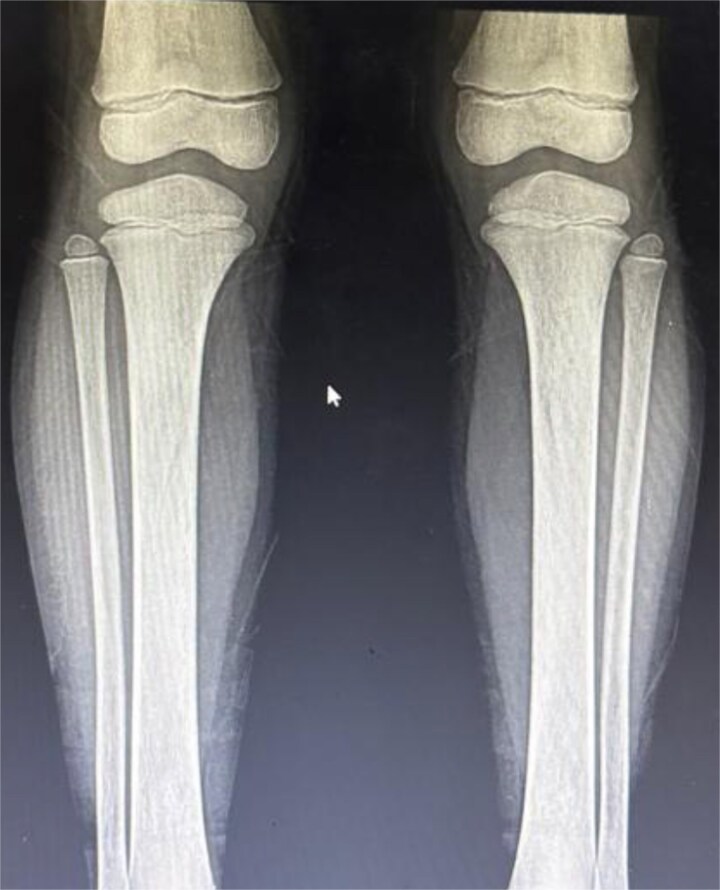 A rare case of Langerhans cell histiocytosis with unexplained endocrine dysfunction and extensive skeletal involvement in a Pediatric patient.