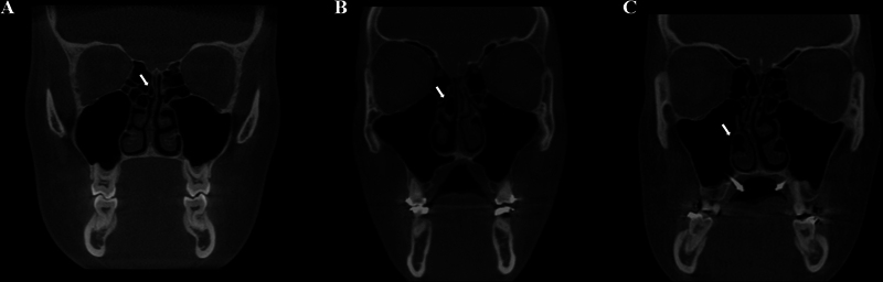 Is Concha Bullosa Associated with Nasal Septum Deviation and Mucosal Thickening of the Maxillary Sinuses? A Cone Beam Computed Tomography Study.