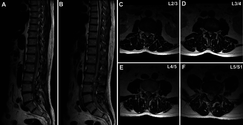 Subdural and epi-arachnoid hemorrhage following spinal epidural block requiring hematoma removal: illustrative case.
