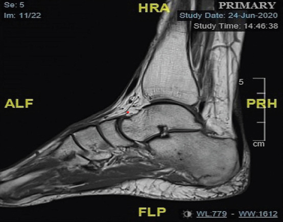Calcaneus and Traumatic Stress Fracture.