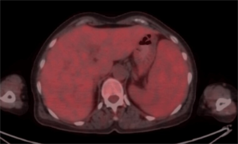 A hidden clue behind angioedema in an elderly patient.