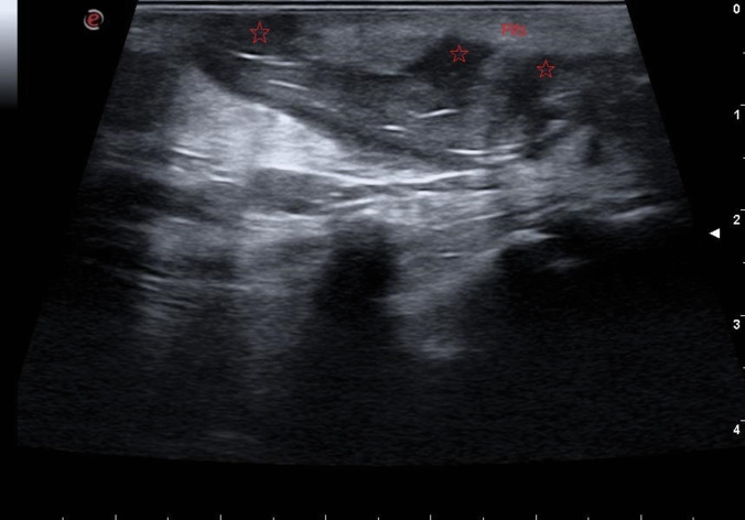 Intra-operative ultrasound in the surgical treatment of complex and recurrent pilonidal disease: a retrospective, observational, single-center study.
