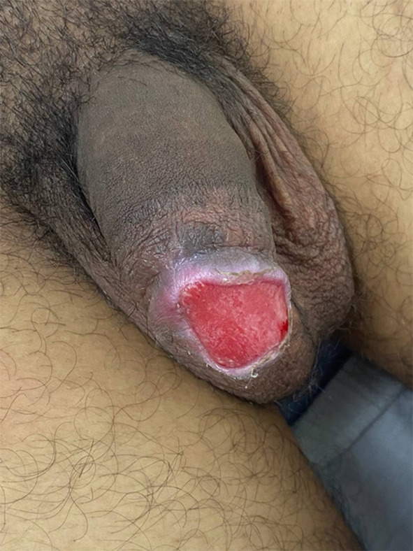 Balanitis Circumscripta Plasmacellularis in a Young Circumcised Male: A Case Report.