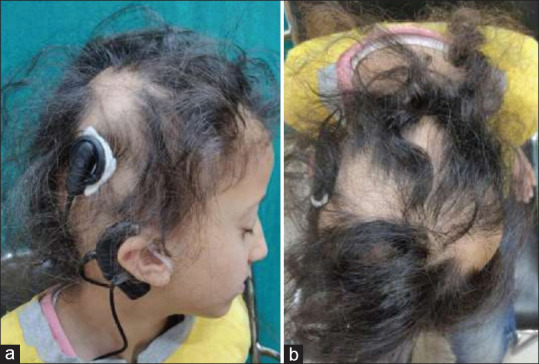 Role of Trichoscopy in diagnosing Genotrichosis-A Report of Two Cases.