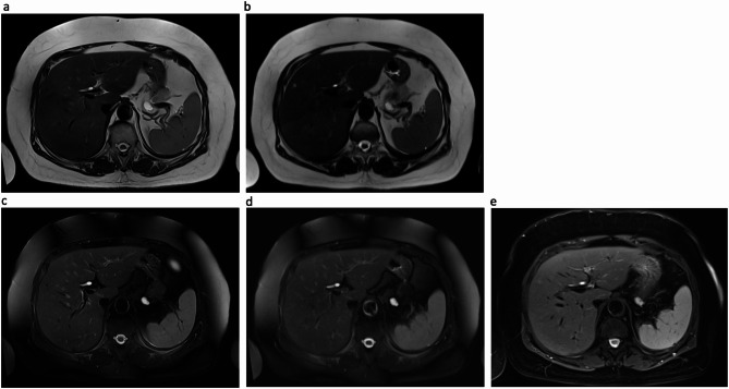 Optimized deep learning-accelerated single-breath-hold abdominal HASTE with and without fat saturation improves and accelerates abdominal imaging at 3 Tesla.