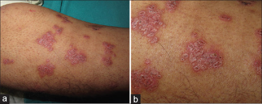 Grouped Inflamed and Umbilicated Papules: A Distinct Clinical Presentation of Perforating Sarcoidosis.