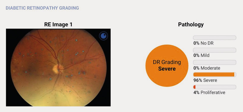 Automated Diabetic Retinopathy Screening in Out-patient Diabetes Care - Comparison of Two Artificial Intelligence Algorithms: RetCAD and OphtAI.