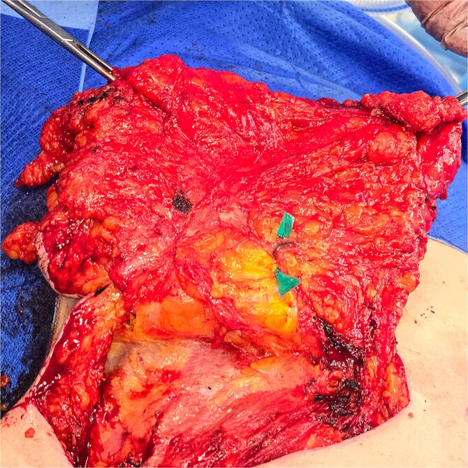 Pedicled transverse rectus abdominis myocutaneous flap removal after 21 years: a case report.