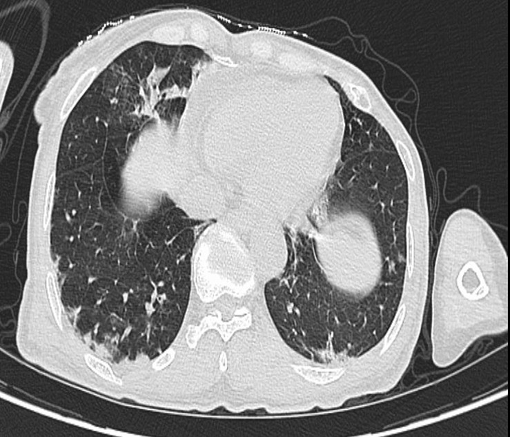 Anti-MDA5 Positive Dermatomyositis Overlapping with Rheumatoid Arthritis: A Case Report.