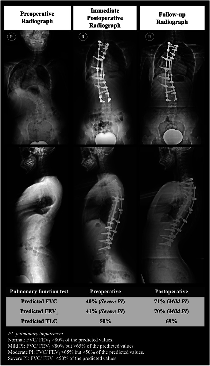 Impact of Posterior Spinal Fusion on Pulmonary Function in Patients With Severe Adolescent Idiopathic Scoliosis (Major Cobb Angle ≥90°).