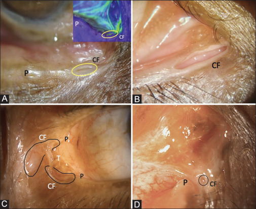 Post-traumatic canalicular fistula following dacryocystorhinostomy surgery.