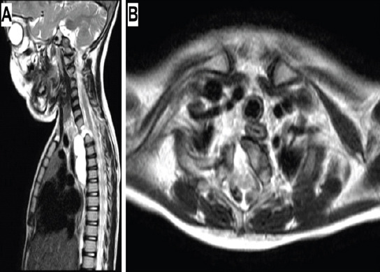Isolated Anterior Extradural Enterogenous Cyst of the Thoracic Spine Mimicking an Anterior Thoracic Meningocele: A Case Report.