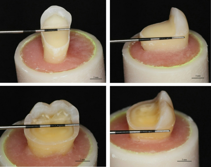 Two different short fiber-reinforced resin composites for extensive MOD cavities in premolars and molars.